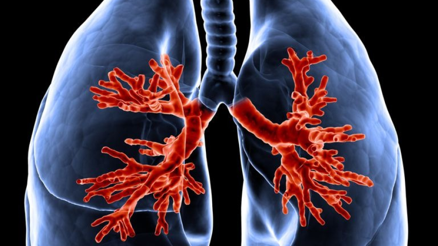 Buscan concientizar sobre ‘rara’ enfermedad que afecta la función pulmonar