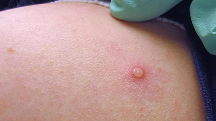 Confirma SST tercer caso de viruela símica, pide reforzar medidas preventivas