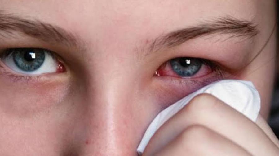 Temen médicos propagación de la conjuntivitis en Matamoros 