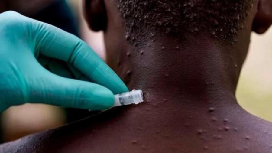 La OMS convoca a reunión de emergencia por aumento de casos de viruela del mono