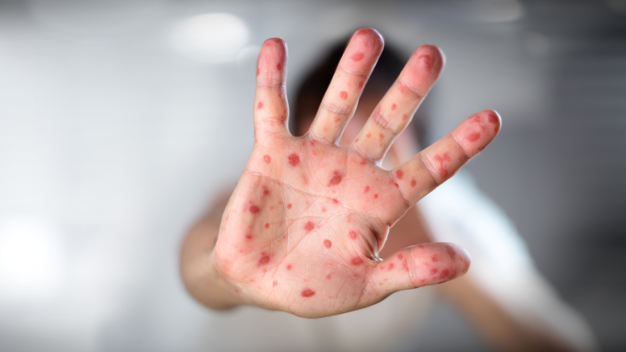 Suma México 2 mil 654 casos confirmados de viruela del mono