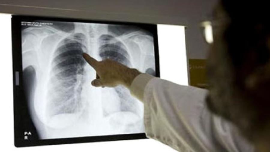 Detectan 119 casos de tuberculosis 