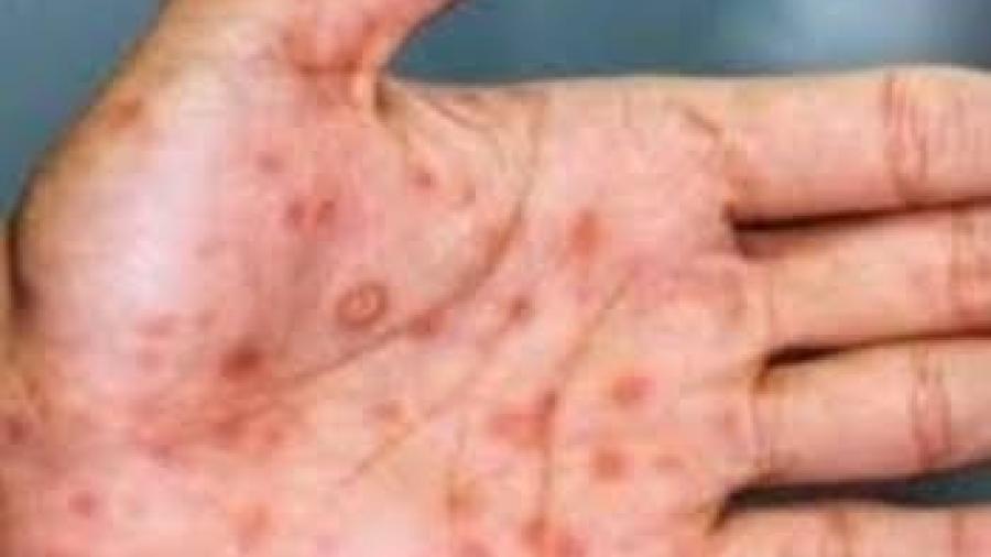 Casos globales de viruela del mono ascienden a 14 mil en más de 70 países