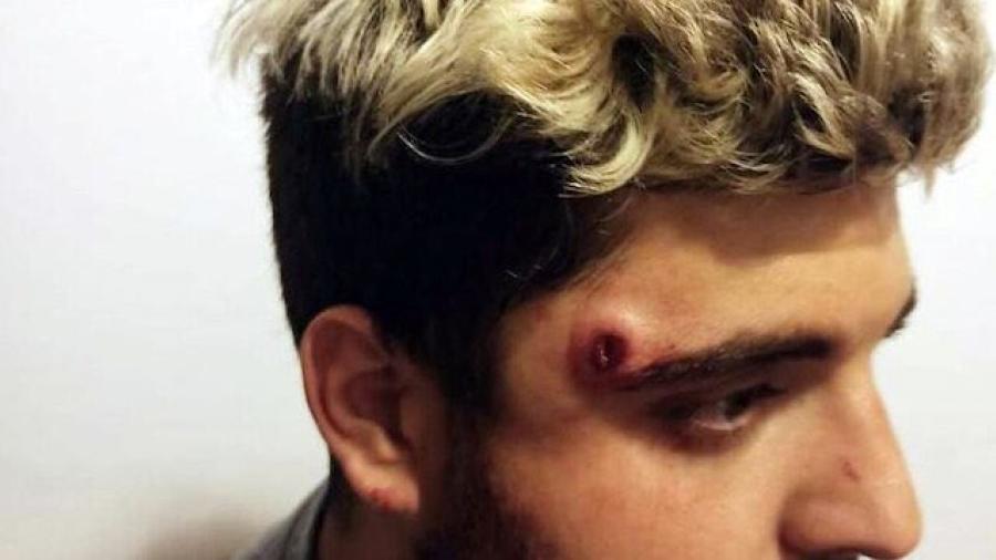 ¡De no creerse! Jugador de rugby recibe balazo en la cabeza y solo tuvo un raspón