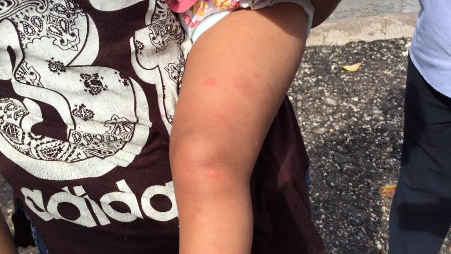 Surgen brotes de infección en la piel, tras inundaciónes