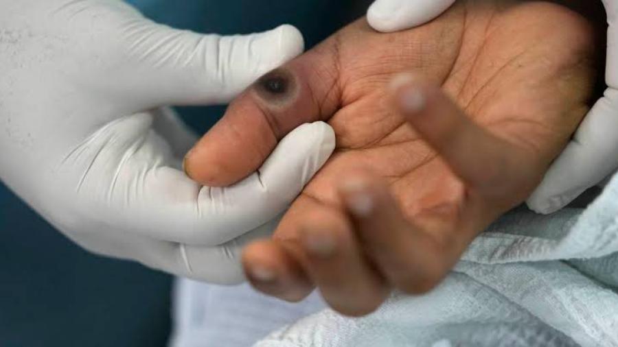 SSA confirma 51 casos de mpox en dos semanas