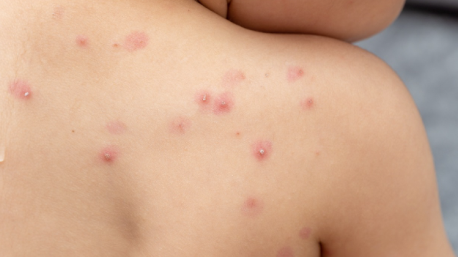 Alerta OPS sobre que América es el epicentro de la viruela del mono