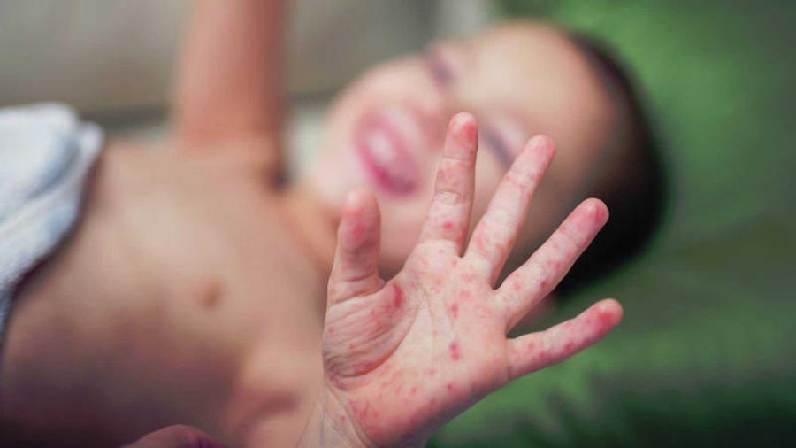 Detectan 60 nuevos casos de sarampión en EU