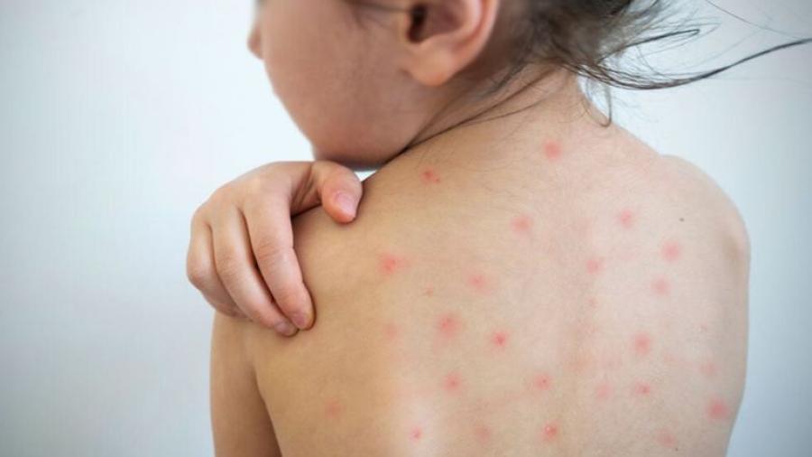 México registra más de 5 mil casos de sarampión; 64 siguen activos