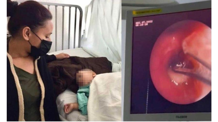 Médicos de Sonora extraen frijol crudo a niño que le impedía respirar Sonora