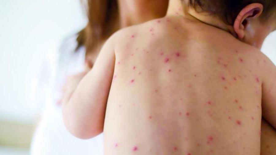 Filipinas declara un brote de sarampión