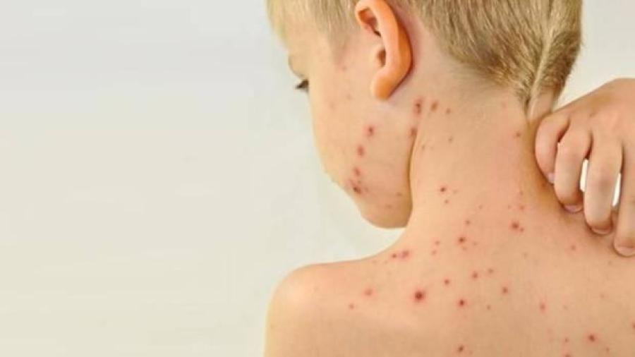 Brote mortal de sarampión en Europa: OMS