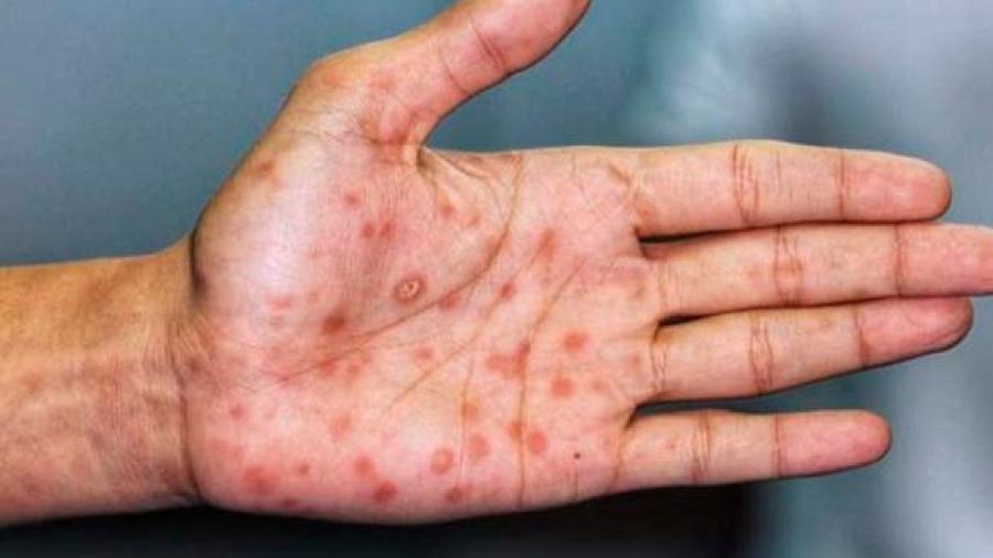Disminuyen casos de viruela del mono en el mundo en la última semana: OMS 
