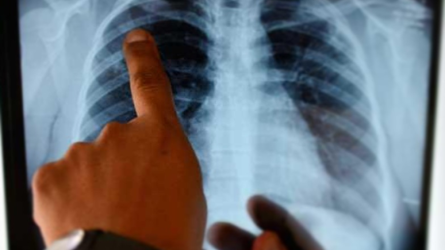 Crecen casos de tuberculosis en invierno