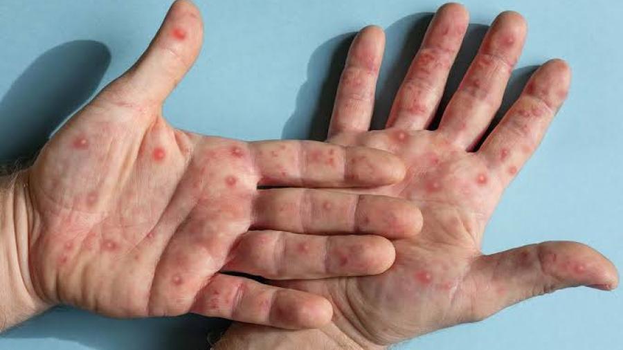 México registra cinco muertes por viruela del mono