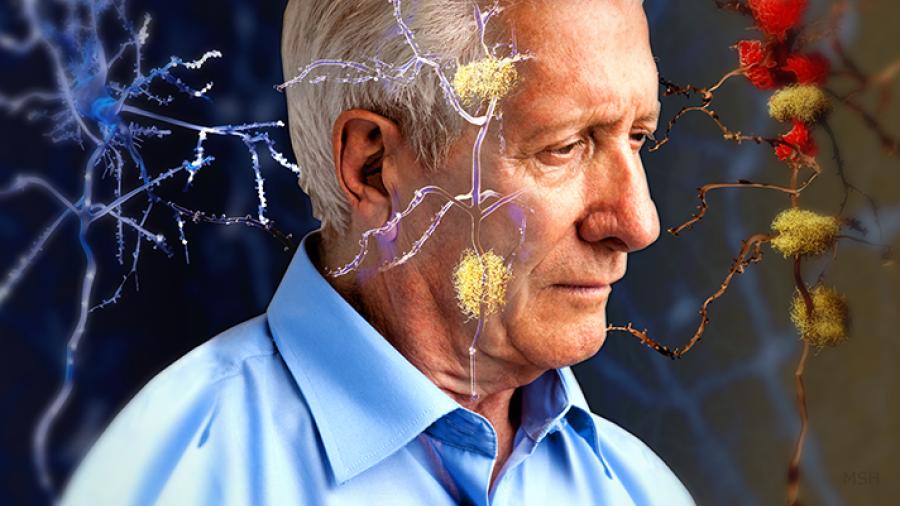 Examen de sangre podría detectar Alzheimer 10 años antes de su primer síntoma