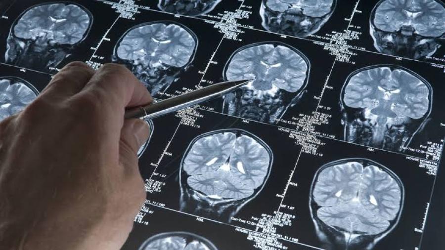 Lanzan en Condado Starr estudio sobre el alzheimer