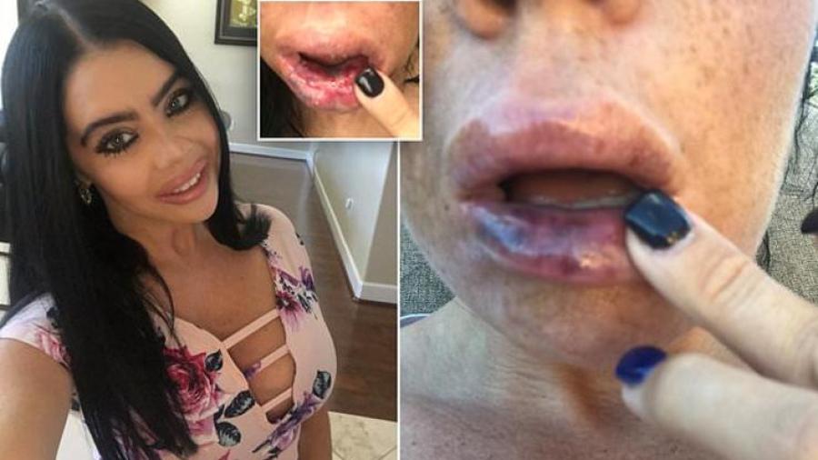 Mujer queda irreconocible tras mal procedimiento de relleno