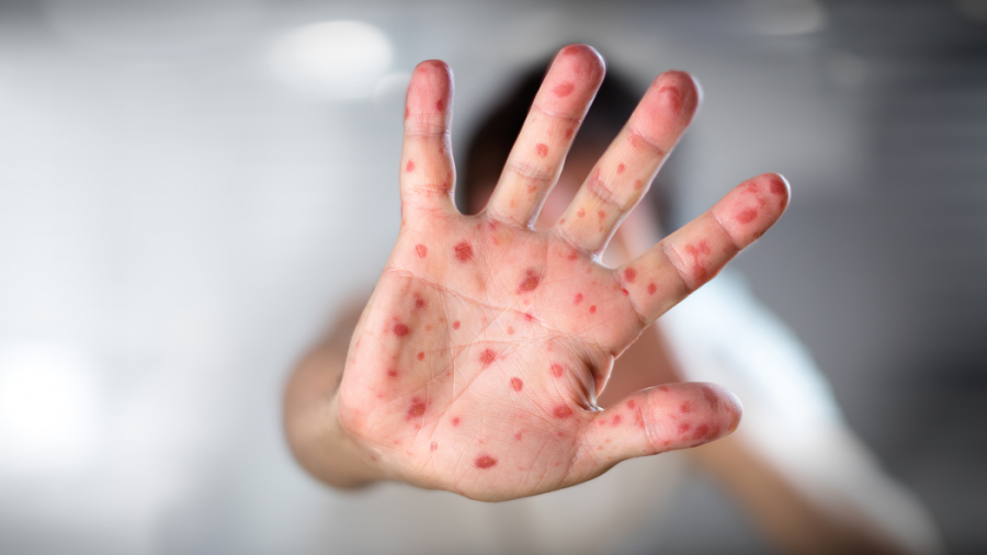 Reporta México 2 mil 901   casos confirmados de viruela del mono