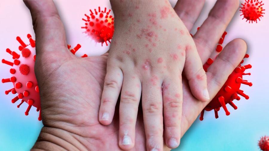 México registra 74 casos activos de sarampión; Salud refuerza vacunación y vigilancia epidemiológica