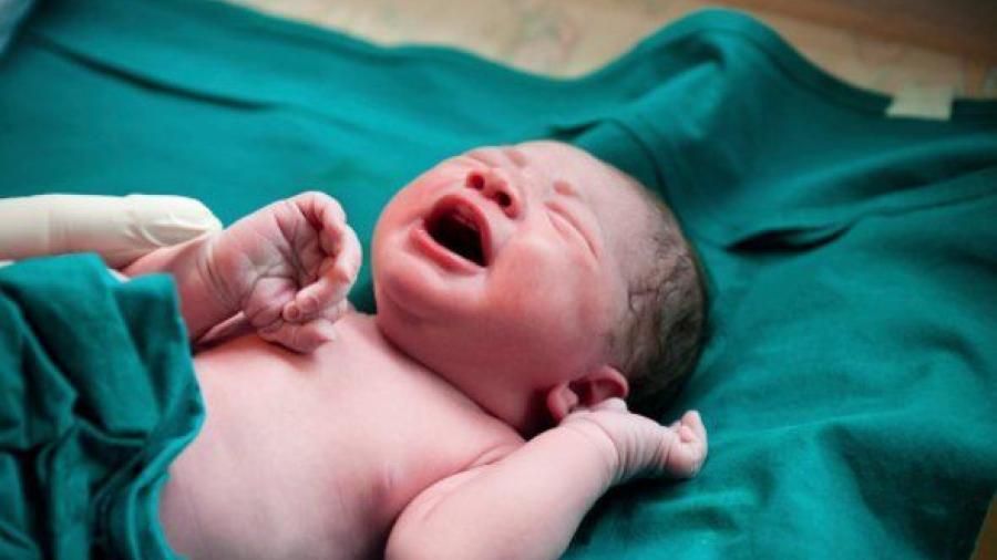 Nace bebé con sirenomelia en India