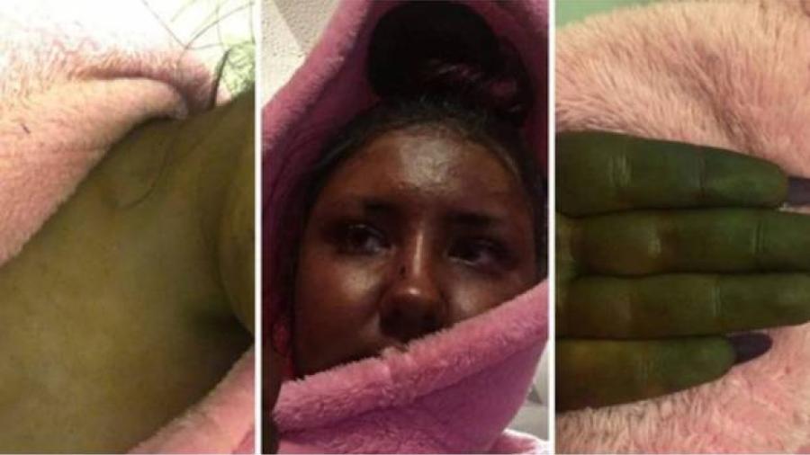 Bronceador le deja la piel verde y la comparan con fiona