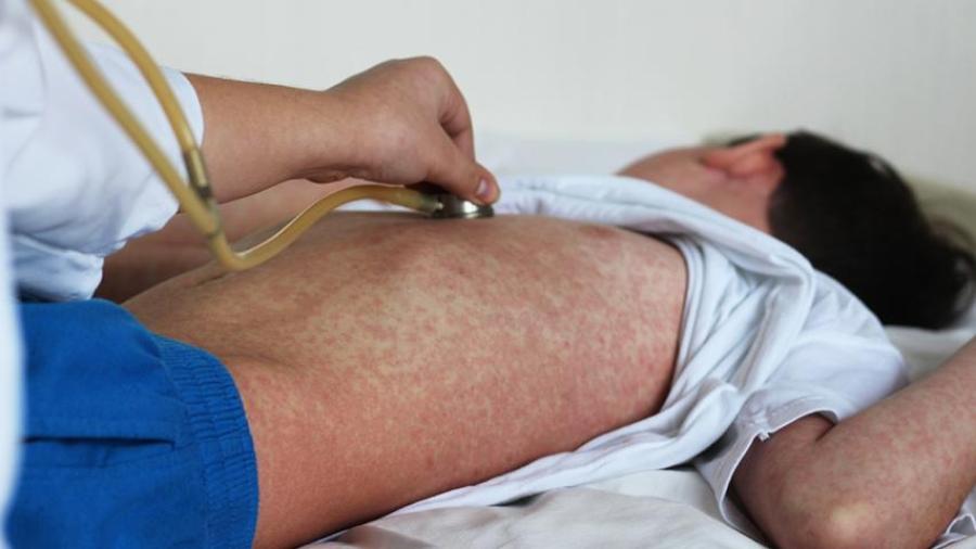 Secretaría de Salud emite alerta epidemiológica ante aumento de casos de sarampión en el mundo