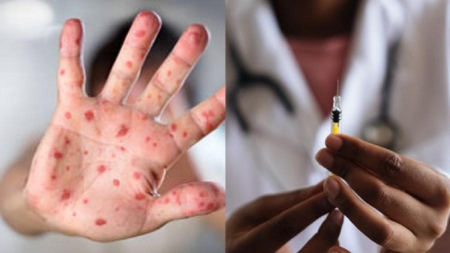 Confirman primer caso de viruela del mono en Sinaloa 