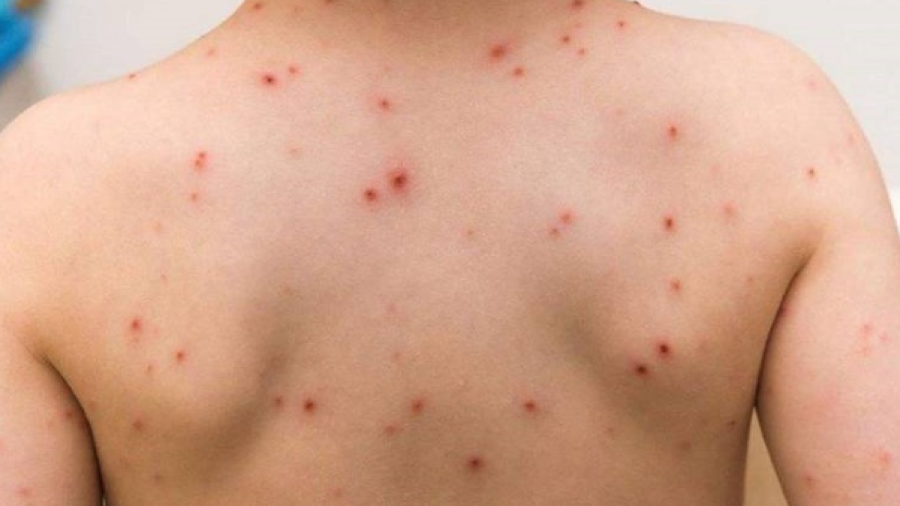 Suman mil 968 casos de viruela símica en México