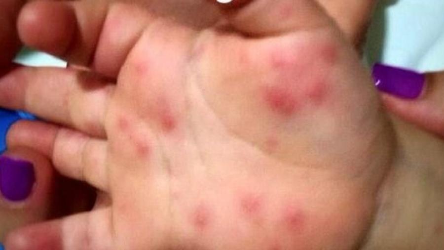 Previenen sobre virus que se presenta en menores
