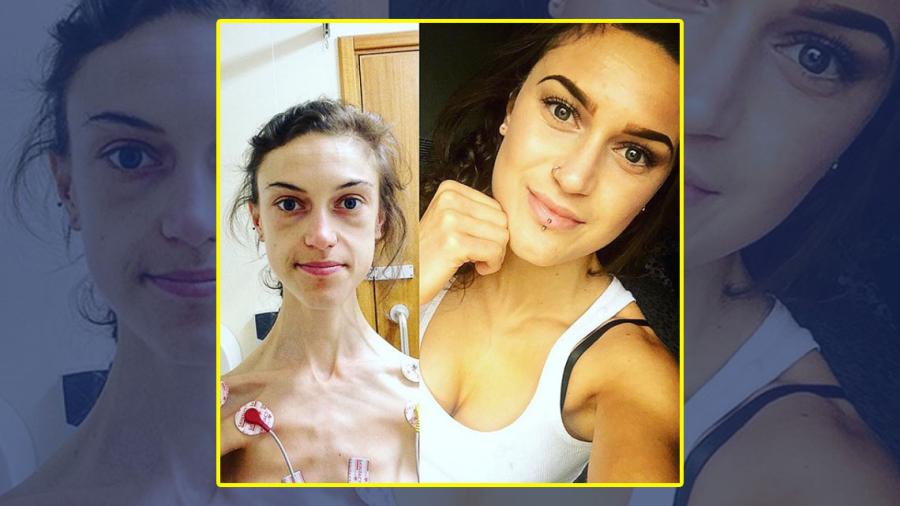 Chica muestra su recuperación tras anorexia