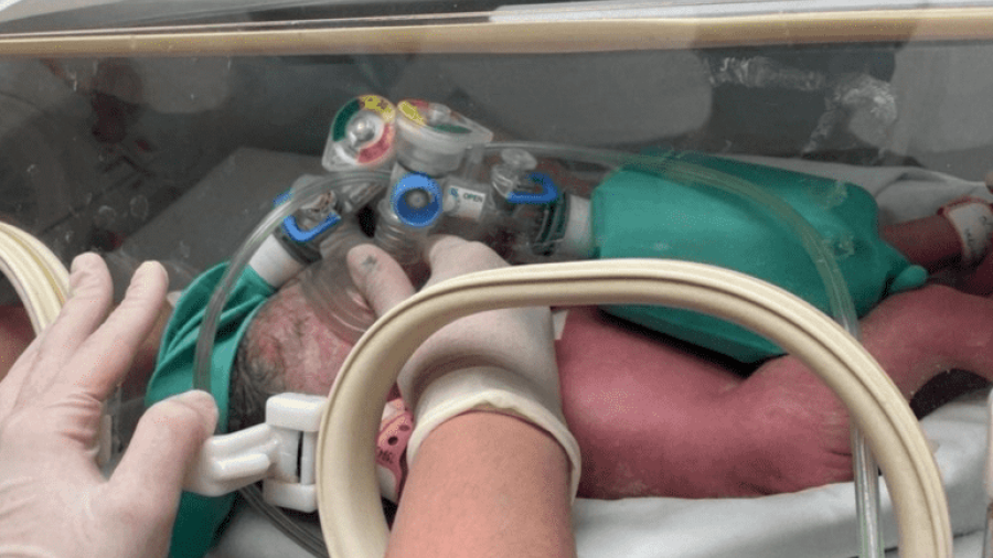 Nacen siamesas en el Hospital Regional Materno Infantil en NL