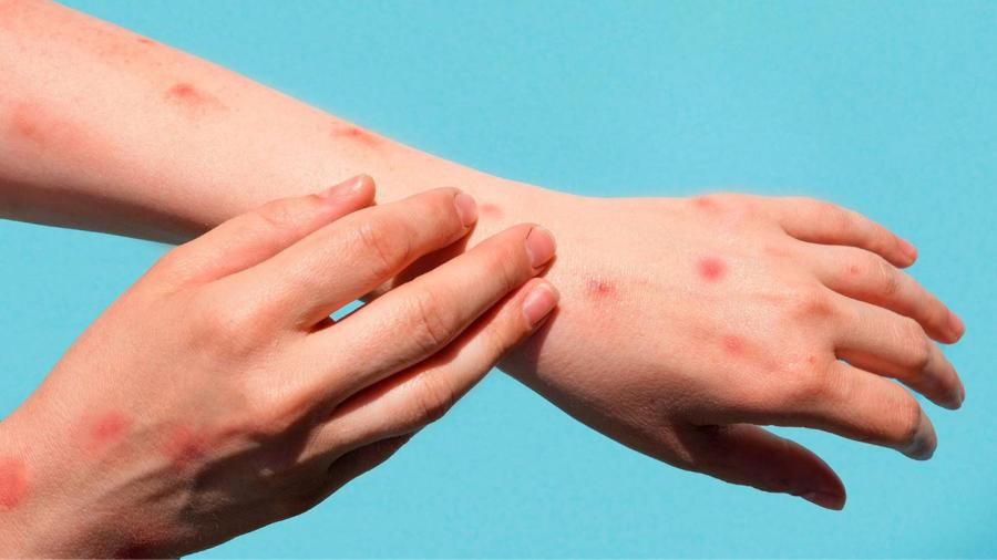 Suman 5 casos de viruela del Mono en México