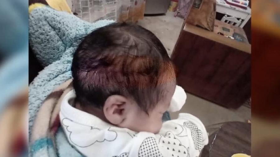 Cortan 15 centímetros de cabeza a bebé durante cesárea en IMSS 